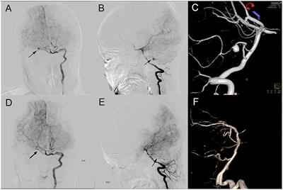 Anterior Inferior Cerebellar Aneurysm Treated by Aneurysm Resection and Intracranial Artery Anastomosis in situ: A Case Report and Literature Review